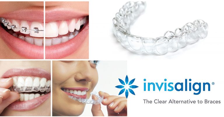 Invisalign-fdc